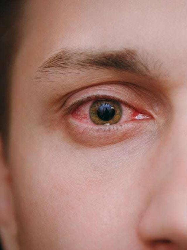 Cases of eye flu are increasing in the country, if you see these symptoms then contact the doctor