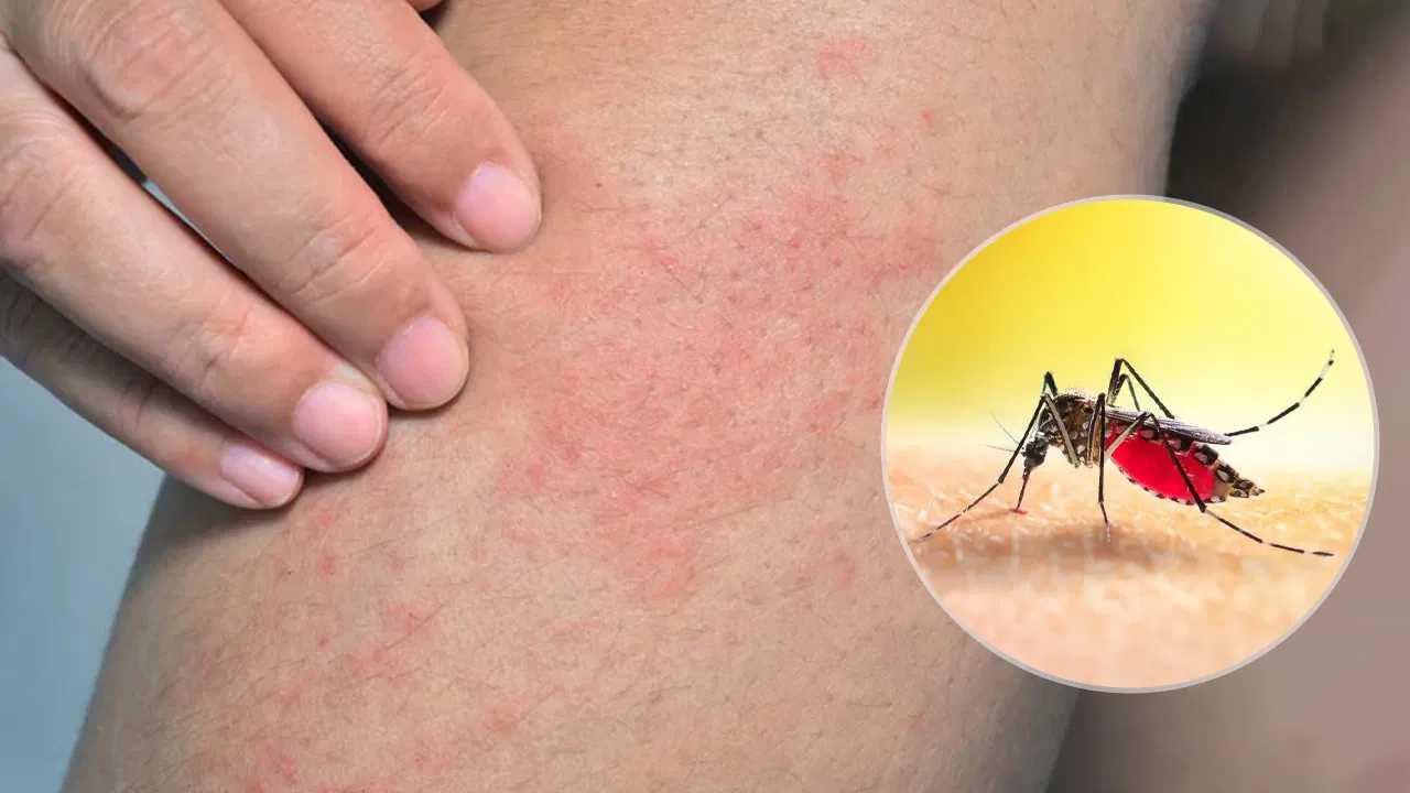 What to do to prevent dengue?