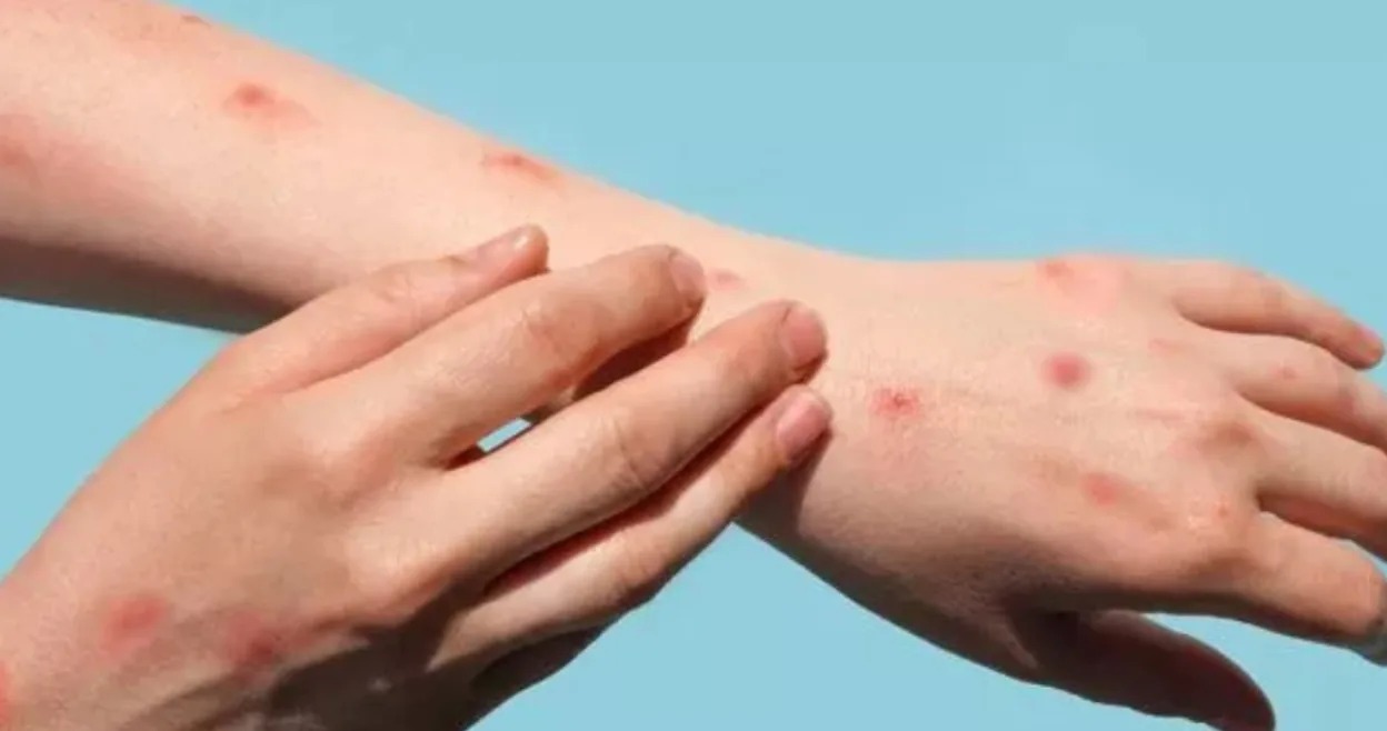 WHAT IS MPOX OR MONKEY POX