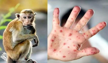 मंकीपॉक्स Monkey pox