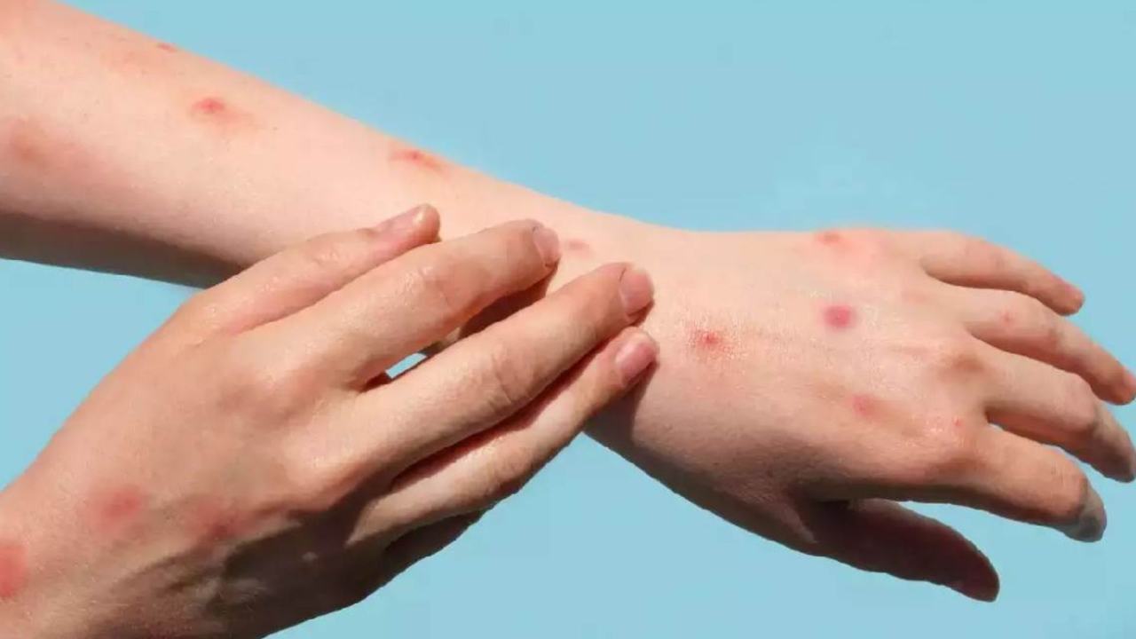 Third patient of monkeypox found in India
