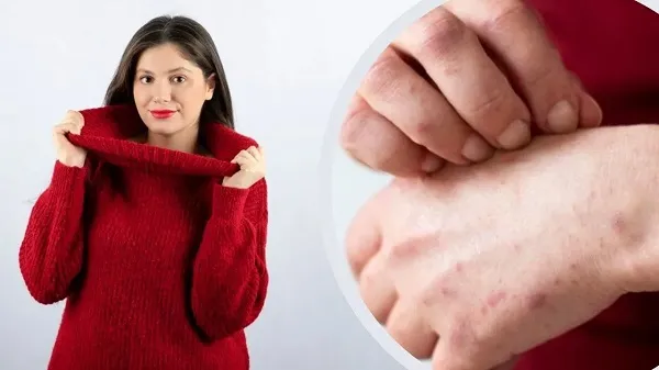 Woolen Sweater Allergy Textile Dermatitis